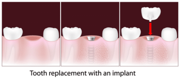 What is an implant