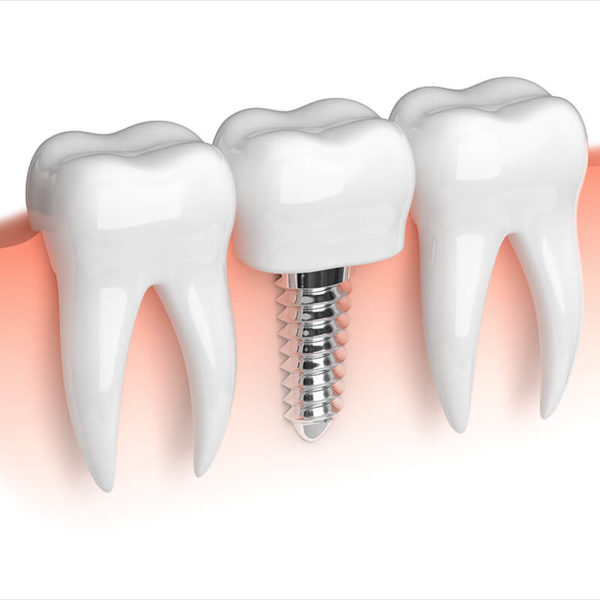 cut-away sketch showing dental implant