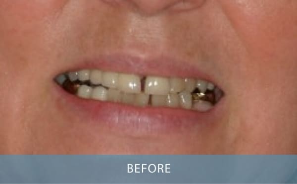 example NOVO Dental work - Porcelain Crown Before