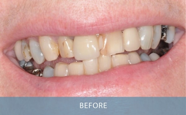 example Dental work Anterior Porcelain Crowns Before