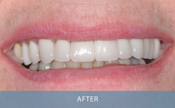 example Dental work Anterior Porcelain Crowns After