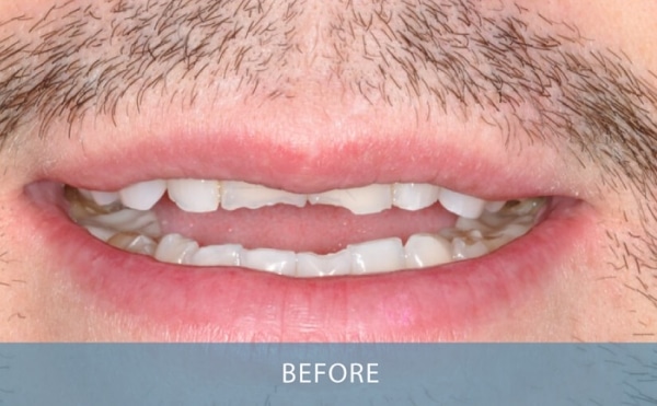 example NOVO Dental work - Chipped Worn Teeth Veneers Porcelain Crowns Before