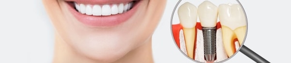Dental Implants can replace missing teeth