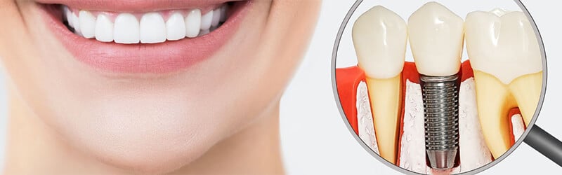 Dental Implants - replace missing teeth - NOVO Dental