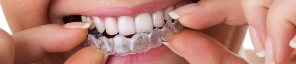 Straighten Your Smile at NOVO Dental