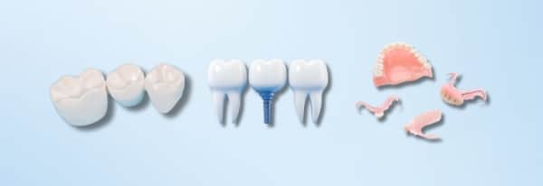 Options for missing teeth, implant, denture or bridge