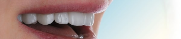 Dental Veneers on front teeth