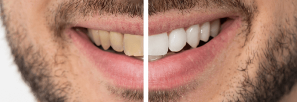 NOVO Dental Centrer -Teeth Whitening services